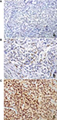 Meningiomas in Premenopausal Women: Role of the Hormone Related Conditions